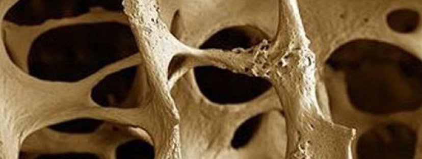 Osteoporoz